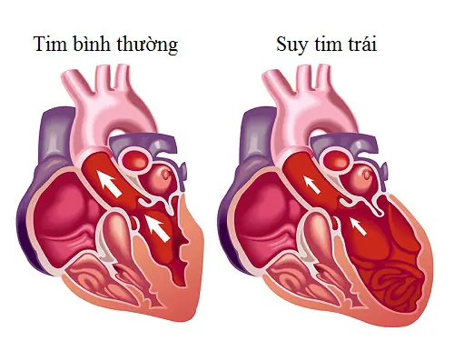 Suy tim trái là tình trạng tâm thất trái không thể bơm đủ máu giàu oxy đi khắp cơ thể